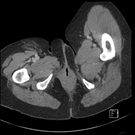 File:Breast metastases from renal cell cancer (Radiopaedia 79220-92225 C 134).jpg