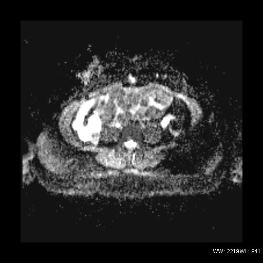 File:Broad ligament fibroid (Radiopaedia 49135-54241 Axial ADC 3).jpg