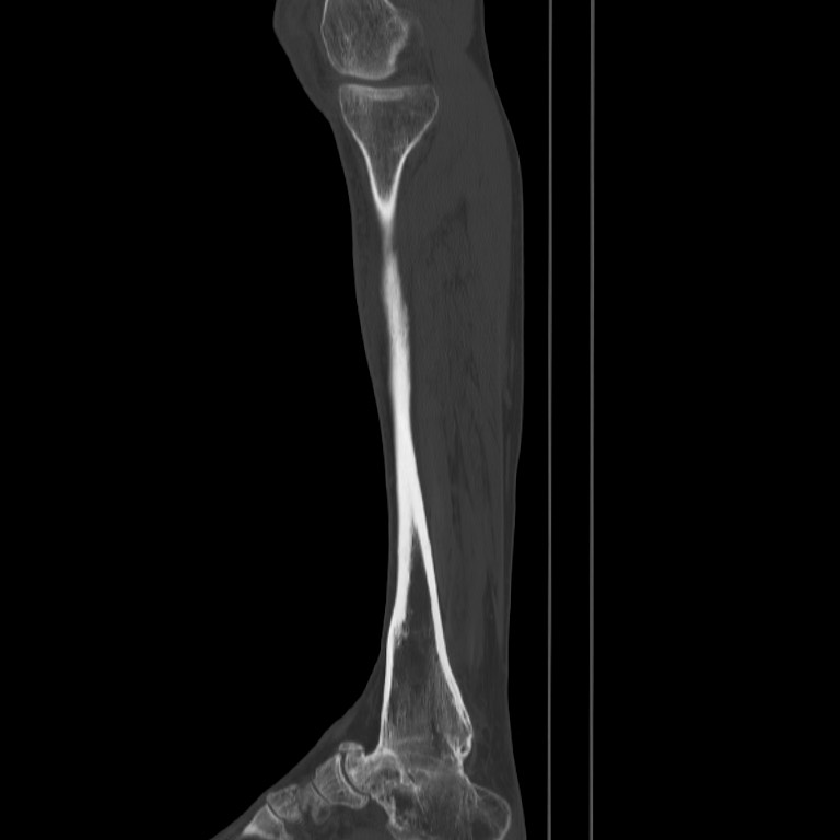 Brodie abscess - tibia (Radiopaedia 66028-75204 Sagittal bone window 18).jpg