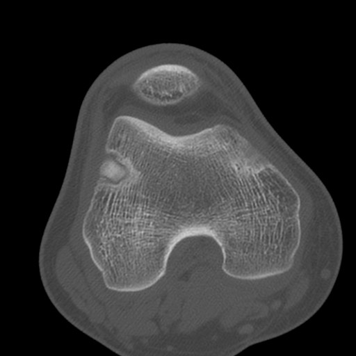 Brodie abscess of the tibia (Radiopaedia 58984-66250 Axial bone window 38).jpg