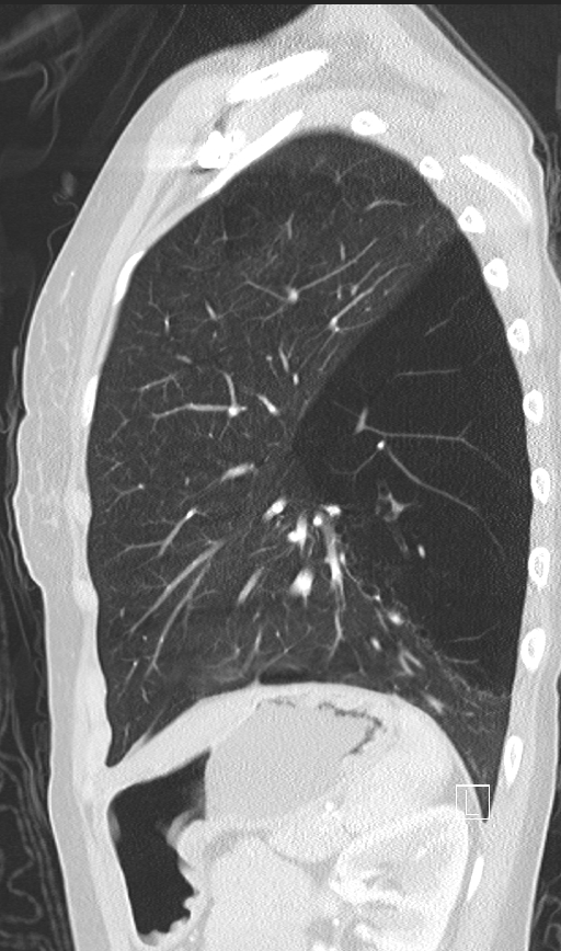 Bronchial atresia (Radiopaedia 73677-84470 Sagittal lung window 40).jpg