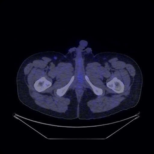 Bronchial carcinoid tumor (Radiopaedia 67377-76765 68Ga-DOTATATE PET-CT 77).jpg