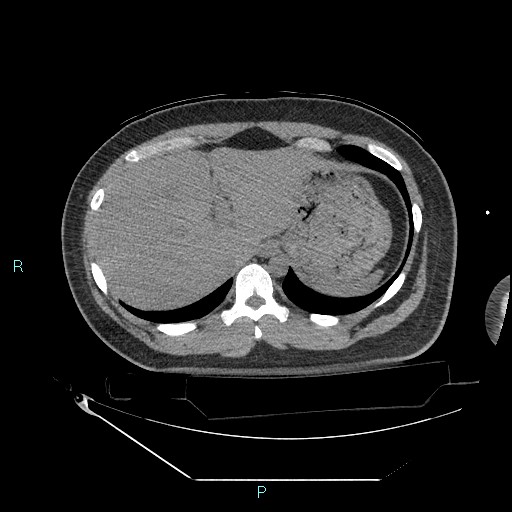 Bronchial carcinoid tumor (Radiopaedia 78272-90870 Axial non-contrast 96).jpg