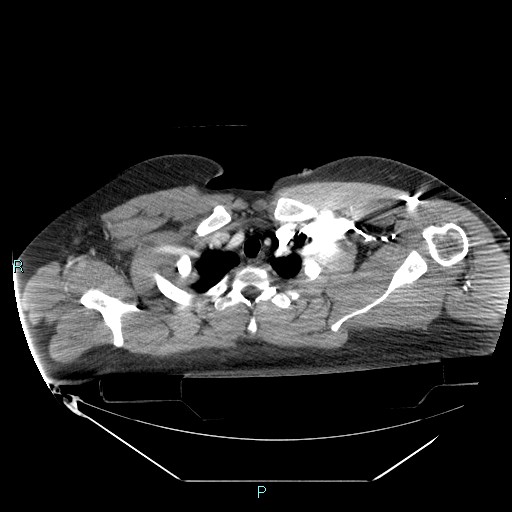Bronchial carcinoid tumor (Radiopaedia 78272-90870 B 21).jpg