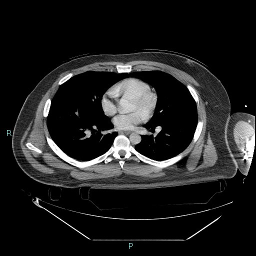 Bronchial carcinoid tumor (Radiopaedia 78272-90870 C 68).jpg