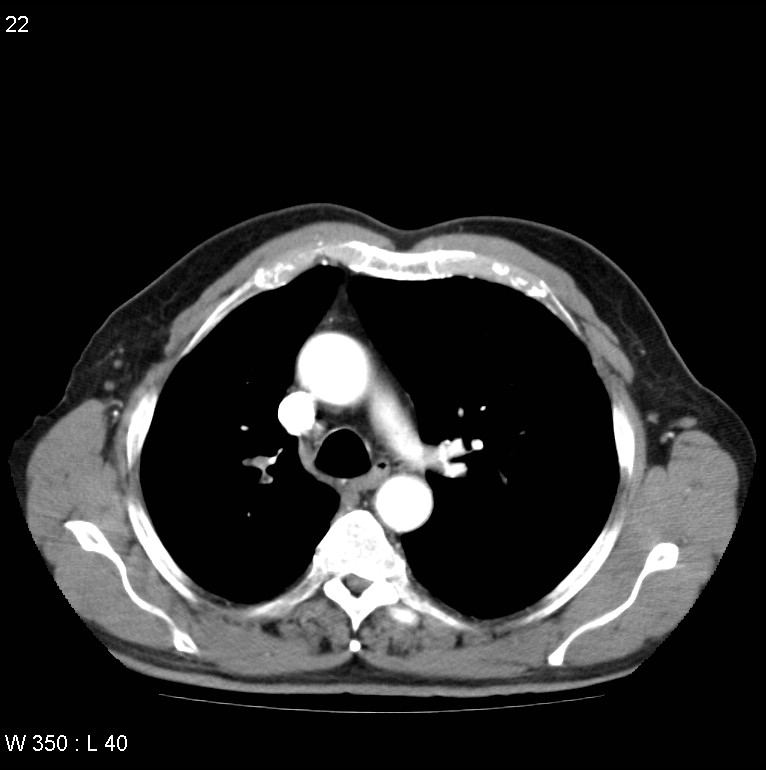 Bronchial carcinoid tumor with right lower lobe collapse (Radiopaedia 29060-29422 A 21).jpg