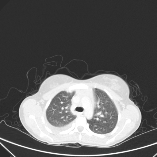 Bronchial mucoepidermoid carcinoma (Radiopaedia 57023-63895 Axial lung window 32).jpg