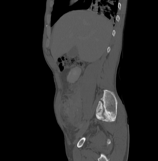 Bronchiectasis in Crohn disease (Radiopaedia 60311-67977 Sagittal bone window 60).jpg