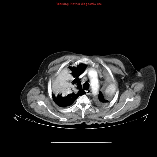File:Bronchioloalveolar carcinoma (Radiopaedia 9272-9955 A 7).jpg