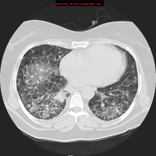 Bronchoalveolar carcinoma (Radiopaedia 13224-13233 Axial lung window 29).jpg