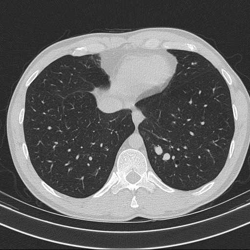 File:Bronchocele (Radiopaedia 60676-68429 Axial lung window 56).jpg