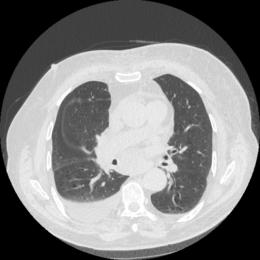 Bronchogenic carcinoma with metastatic lymphadenopathy (Radiopaedia 37671-39569 Axial lung window 29).jpg