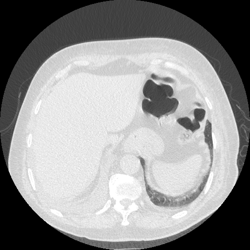 Bronchogenic carcinoma with metastatic lymphadenopathy (Radiopaedia 37671-39569 Axial lung window 48).jpg