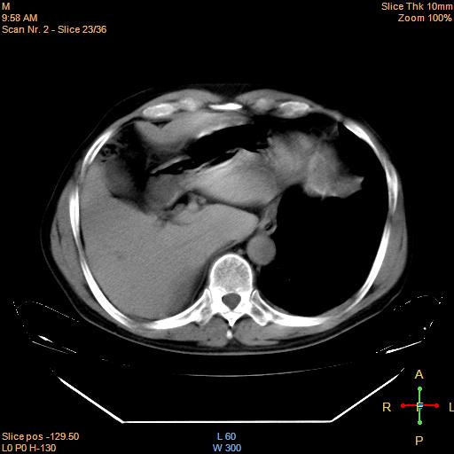 File:Bronchogenic carcinoma with superior vena caval invasion (Radiopaedia 22378-22406 Axial liver window 20).jpg