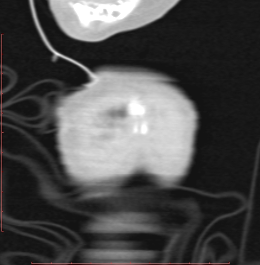 Bronchogenic cyst (Radiopaedia 78599-91409 Coronal lung window 5).jpg