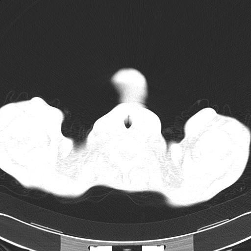 Bronchopleural fistula secondary to tuberculosis (Radiopaedia 20415-20322 Axial lung window 2).jpg