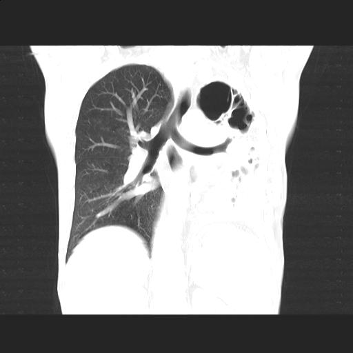 File:Bronchopleural fistula secondary to tuberculosis (Radiopaedia 20415-20322 Coronal lung window 13).jpg