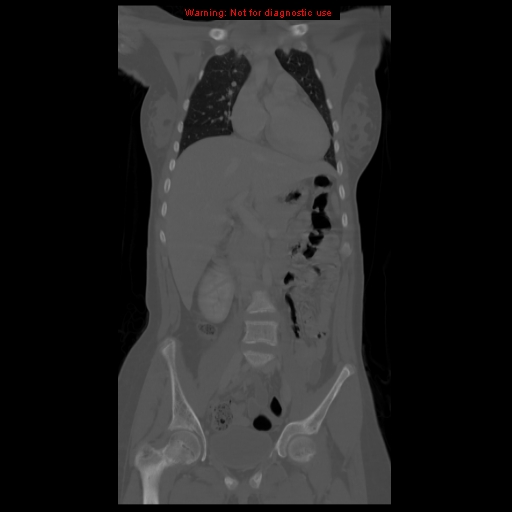File:Brown tumor (Radiopaedia 12318-12596 D 29).jpg