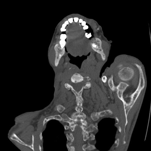 File:Brown tumor with secondary hyperparathyroidism (Radiopaedia 23591-23705 C 18).jpg