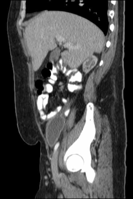 Brown tumors compressing the spinal cord (Radiopaedia 68442-77988 F 18).jpg