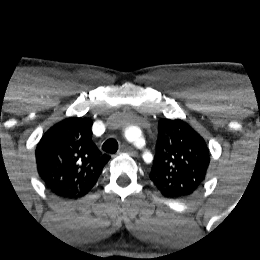 Buccal fat pad arteriovenous malformation (Radiopaedia 70936-81144 D 3).jpg
