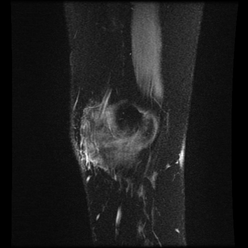 Bucket handle meniscus tear (Radiopaedia 56916-63751 H 79).jpg