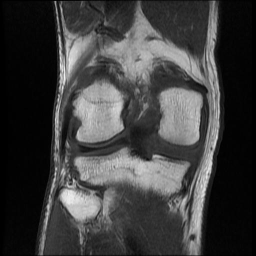 File:Bucket handle tear - medial meniscus (Radiopaedia 69245-79026 Coronal T1 14).jpg