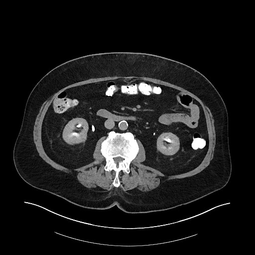 File:Buried bumper syndrome - gastrostomy tube (Radiopaedia 63843-72575 Axial 81).jpg