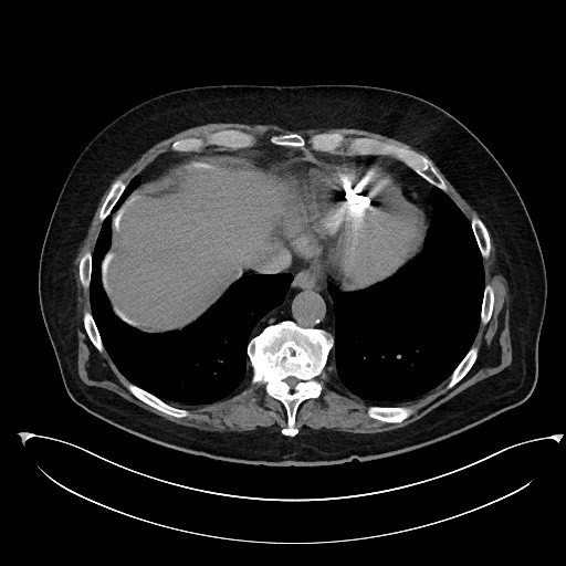 File:Buried bumper syndrome - gastrostomy tube (Radiopaedia 63843-72577 Axial Inject 9).jpg