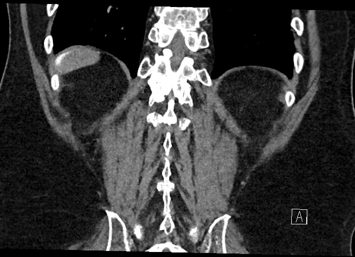 Buried bumper syndrome - gastrostomy tube (Radiopaedia 63843-72577 Coronal Inject 117).jpg