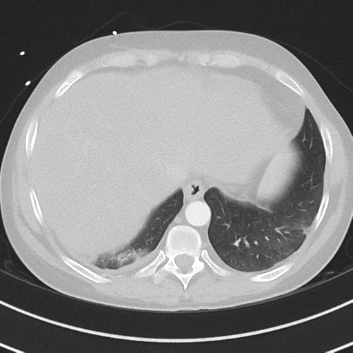 Burkitt lymphoma (Radiopaedia 34686-36121 Axial lung window 40).png