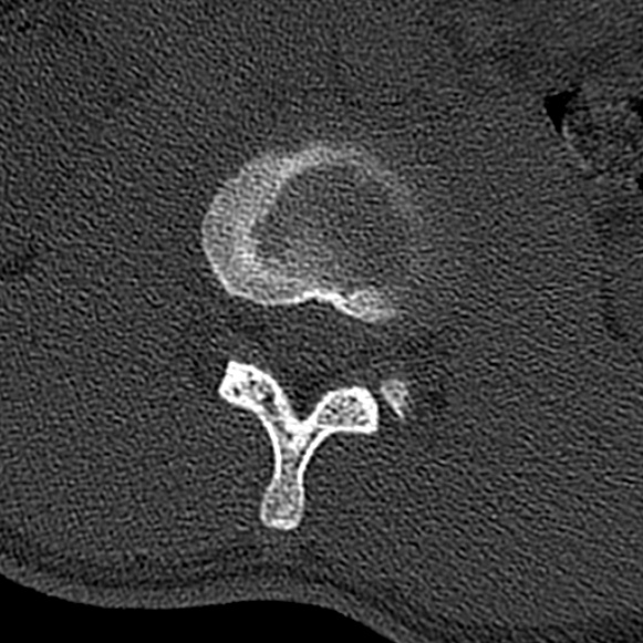 Burst fracture (Radiopaedia 53373-59357 Axial bone window 27).jpg