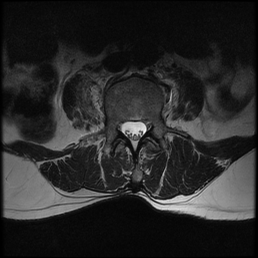 File:Burst fracture - lumbar spine (Radiopaedia 72877-83541 Axial T2 13).jpg