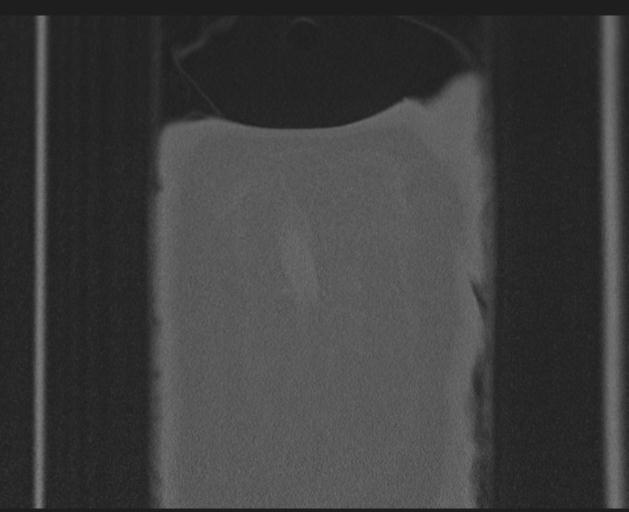 Burst fracture - thoracic spine (Radiopaedia 30238-30865 Coronal bone window 163).jpg