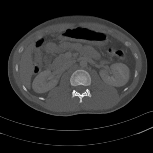 Burst fracture with cauda equina syndrome (Radiopaedia 25701-25867 Axial bone window 19).jpg