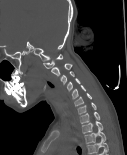 Butterfly vertebra (Radiopaedia 77903-90209 Sagittal bone window 67).jpg
