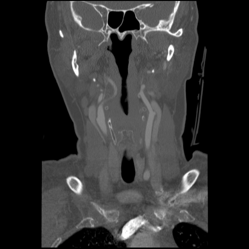 C1 anterior arch (plough) fracture - type 1 (Radiopaedia 76181-87720 Coronal bone window 72).jpg