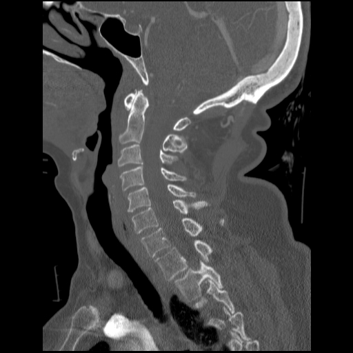 File:C1 anterior arch (plough) fracture - type 1 (Radiopaedia 76181-87720 Sagittal bone window 58).jpg