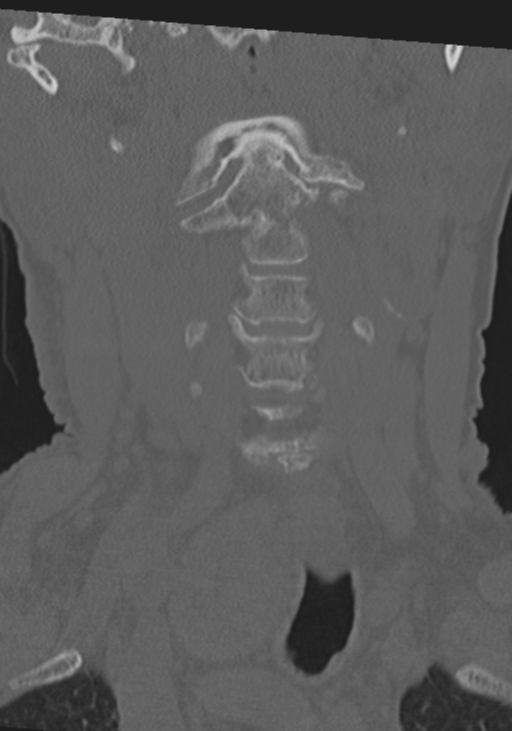 C2 fracture with vertebral artery dissection (Radiopaedia 37378-39199 Coronal bone window 9).png