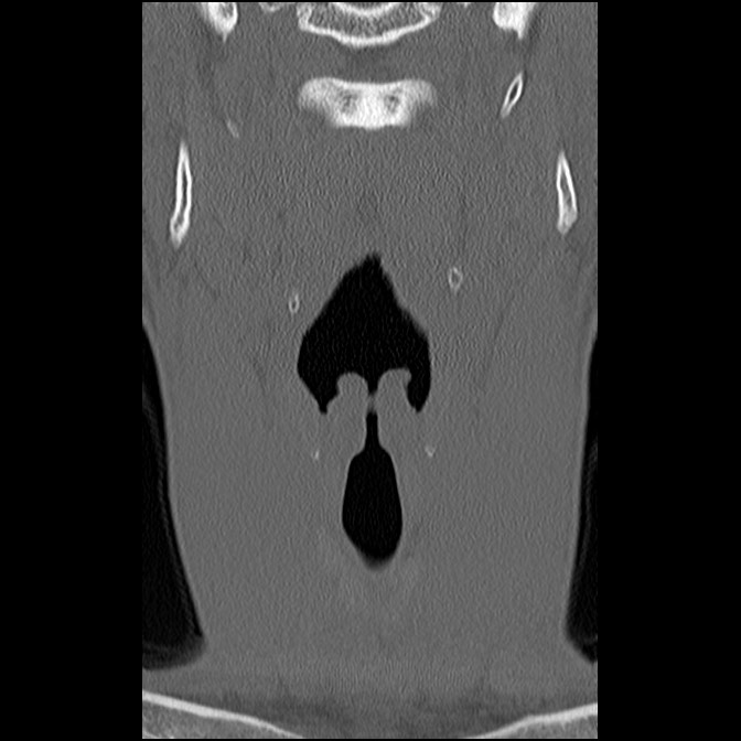 C5 facet fracture (Radiopaedia 58374-65499 Coronal bone window 15).jpg