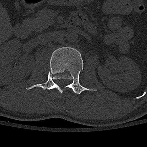 Calcaneal fractures with associated L2 burst fracture (Radiopaedia 71671-82493 Axial bone window 36).jpg