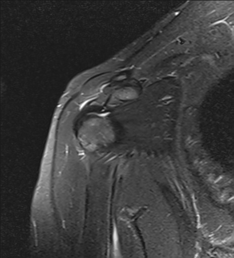 File:Calcific tendinitis of the infraspinatus tendon (Radiopaedia 87256-103537 Coronal PD fat sat 7).jpg
