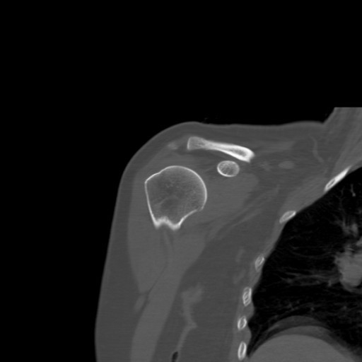 File:Calcific tendinitis of the infraspinatus tendon (Radiopaedia 87256-103539 Coronal bone window 21).jpg