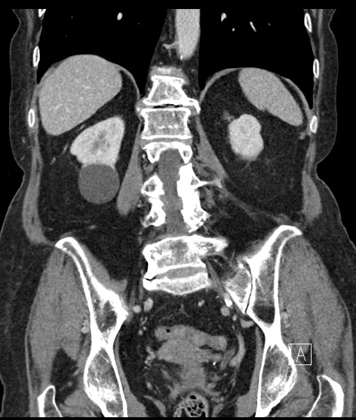Calcified adrenal glands and Spigelian hernia (Radiopaedia 49741-54988 B 80).jpg