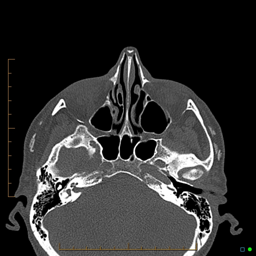 Calcified facial augmentation fillers (Radiopaedia 79514-92679 Axial bone window 3).jpg