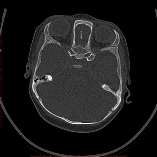 Calcified middle cerebral artery embolism (Radiopaedia 78949-91860 Axial bone window 10).jpg