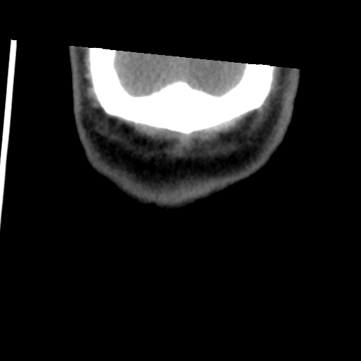 Calcifying pseudoneoplasm of neuraxis (Radiopaedia 44076-47617 Coronal non-contrast 50).png