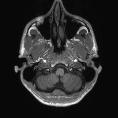 Callosal dysgenesis with interhemispheric cyst (Radiopaedia 53355-59335 Axial T1 19).jpg
