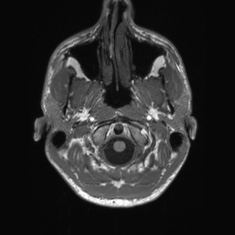 Callosal dysgenesis with interhemispheric cyst (Radiopaedia 53355-59335 Axial T1 7).jpg