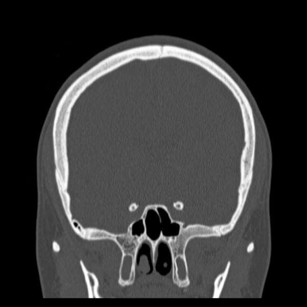 Calvarial osteoma (Radiopaedia 36520-38079 C 37).jpg